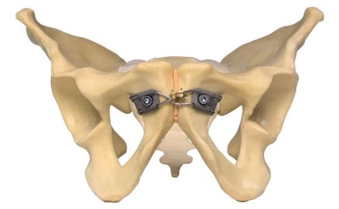 Neuartige Kabel-Klammer-Implantate bei Beckenverletzungen