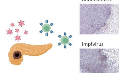Neue Kombinations-Immuntherapie für Bauchspeicheldrüsenkrebs