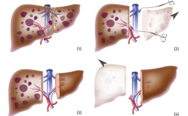 Behandlungsoption bei Lebermetastasen: Zweistufige Transplantation