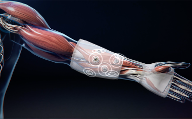 Eine neue Generation von Mikroimplantaten