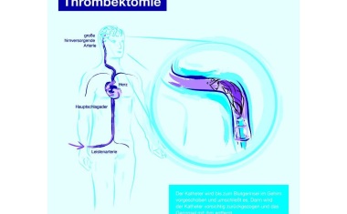 Evidenz für Thrombektomie bei Verschluss intrakranieller Arterien