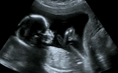 Frühgeborene: Was das Immunsystem anfällig für tödliche Infektionen macht