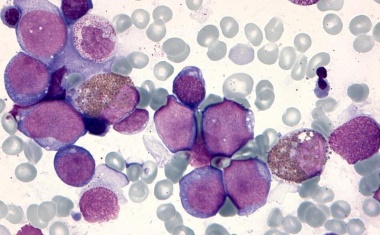 Ursache von Leukämie bei Trisomie 21