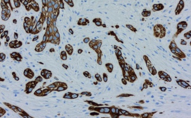 Bauchspeicheldrüsenkrebs: Neuer Ansatz zur Überwindung von Therapieresistenzen