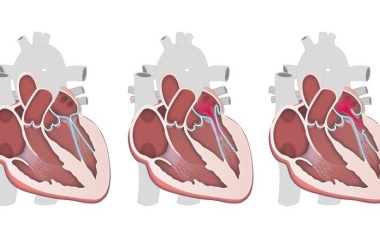 Mitralklappe reparieren: Chirurgisch oder mit Katheter?