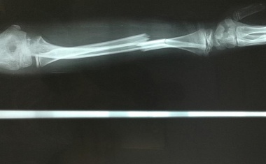 Vorläuferzellen aus dem Knochenmark statt Transplantation