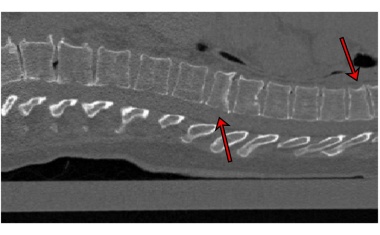 Künstliche Intelligenz für die Osteoporose-Diagnostik