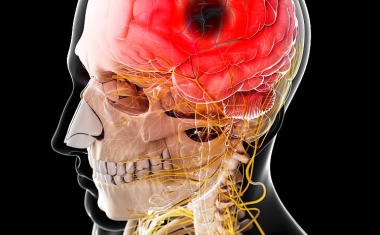 Thrombektomie revolutioniert Schlaganfallbehandlung