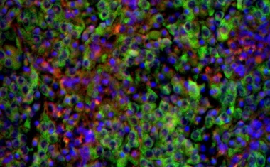 Das Neuroblastom unter der Lupe: Neuer Sonderforschungsbereich an der Charité