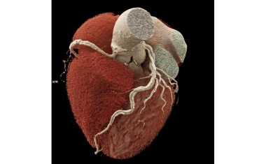 Erstmals nicht-invasive Diagnostik für Hochrisiko- Herzpatienten