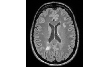 MS: Charité leitet Public-private-Partnership zur Entwicklung einer Diagnoseplattform
