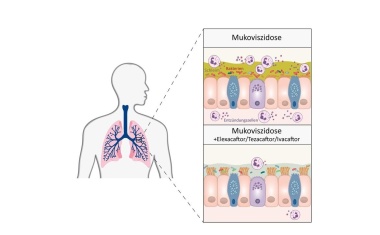 Dreifachtherapie führt zu langanhaltender Verbesserung bei Mukoviszidose