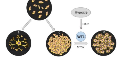 Bösartiger Tumor bei Kindern: Neuer Krankheitsmechanismus aufgedeckt