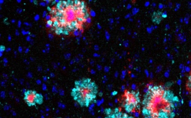 Potenziellen Alzheimer-Marker entdeckt