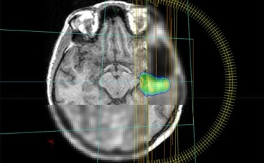Aggressive Hirntumore dank innovativer Bildgebung und KI präzise bestrahlen