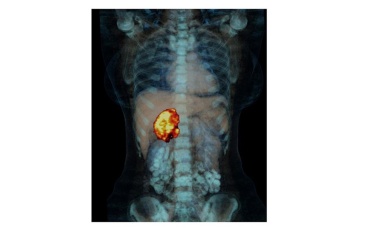 Nebennierenkrebs: Bei niedrigem Rückfallrisiko kein Mitotane