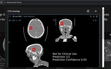 Schnellere und zuverlässigere Schlaganfalldiagnostik mit KI