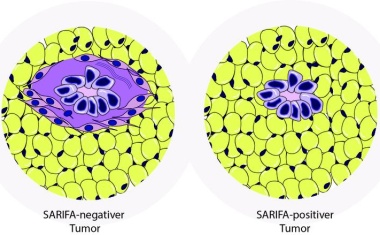 Aggressivität von Magen- und Dickdarm-Tumoren bestimmen