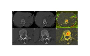 Ein Maß für die Knochenregeneration beim Multiplen Myelom