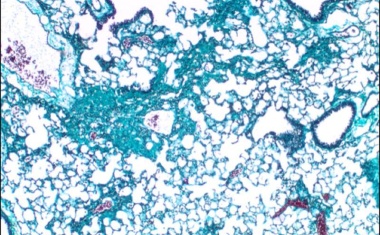 Bisher unbekannte Ursache für die Entstehung der Lungenfibrose entdeckt
