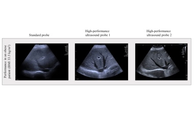 Spezialsonden verbessern Ultraschall bei Menschen mit Adipositas