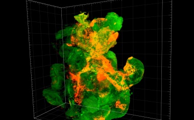 Nanopartikel für optimierte Krebstherapie