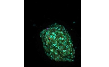 KI in der personalisierten Krebstherapie: Menschen treffen die besseren Entscheidungen