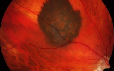 Neuartige Immuntherapie für fortgeschrittenes Melanom des Auges