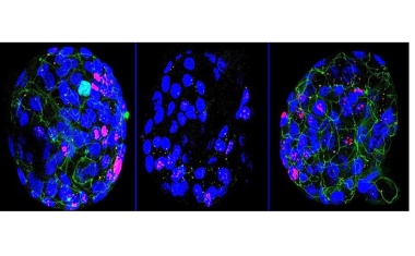 Entzündungsfördernde Immunzellen bei Morbus Crohn entdeckt – und umprogrammiert