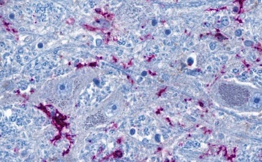 Wie sich COVID-19 auf das Gehirn auswirkt