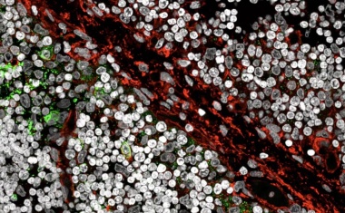 Möglicher Auslöser für Autoimmunerkrankungen entdeckt