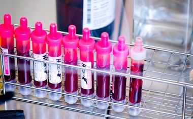 Möglicher neuer Laborwert zur besseren Erkennung zahlreicher Entzündungserkrankungen