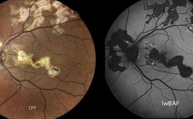 Vereinfachte Diagnose seltener Augenerkrankung