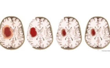 Schlaganfall: Erstmals Hinweise auf wirksame Therapie bei schweren Hirnblutungen