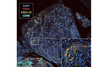Neue Therapieform mit gespiegelter RNA gegen hochaggressive Hirntumore wirksam