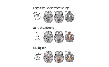 Mikro-Veränderungen im Gehirn bei Post-COVID-Patienten
