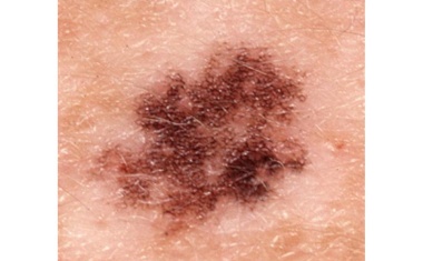 Was Melanome gegen Krebstherapie resistent macht