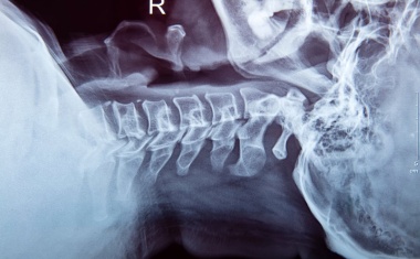 Gewebebrücken sind zuverlässige Prädiktoren zur Genesung bei Halswirbelsäulenverletzungen