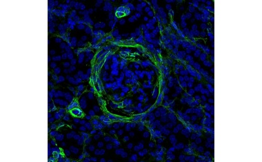 Überraschender Auslöser für Nierenschäden bei Lupus