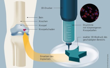 Verstärkung fürs Knie: 3D-Biodruck mit körpereigenen Knorpelzellen