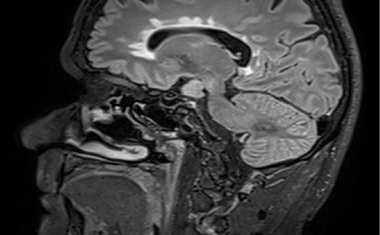 Die Therapie von Multipler Sklerose verbessern