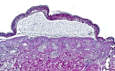 Lebensrettende Behandlung bei tödlicher Hautreaktion