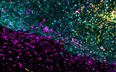 Glioblastom: Neuer Therapieansatz greift Hirntumor mehrfach an