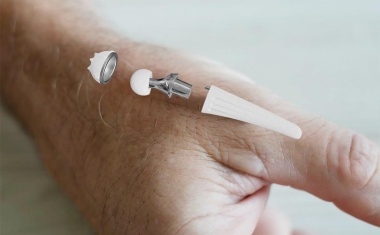 300. Implantation der Touch-Daumensattelgelenksprothese am Rhön-Klinikum Campus Bad Neustadt