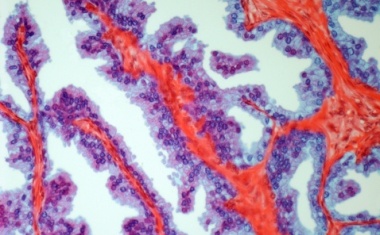 Therapie bei de novo metastasierten hormonsensitiven Prostatakarzinomen