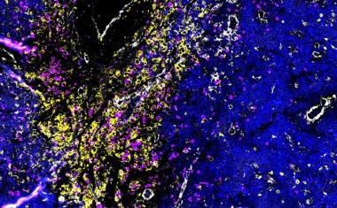 Multiples Myelom: Brechen Krebszellen aus entsteht gefährliche Vielfalt