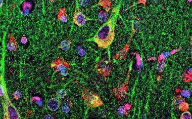 Potentieller Angriffspunkt für MS-Therapie entdeckt