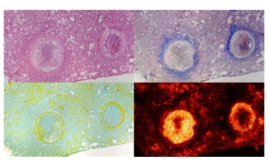 Neuartiges Antibiotikum BTZ-043 erreicht auch Tuberkulosebakterien, die sich in abgestorbenem Lungengewebe verstecken