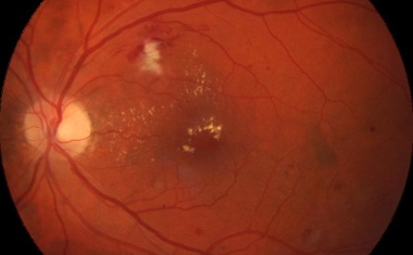Mit KI-generiertem Netzhaut-Screening zur kardiovaskulären Risikovorhersage