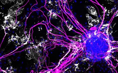 Wie ein Entzündungsbotenstoff Alzheimer anfeuert
